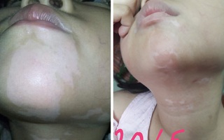 Thành công: Lần đầu tiên "ghép tế bào thượng bì tự thân không qua nuôi cấy" điều trị bệnh bạch biến và các rối loạn giảm sắc tố da 
