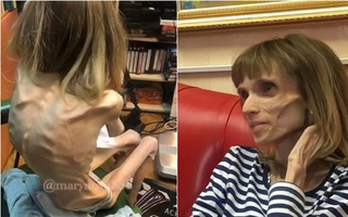 Cô gái da bọc xương nặng vỏn vẹn 17kg từng bị ví như "xác chết trong phim kinh dị" gây xôn xao khắp thế giới giờ ra sao?