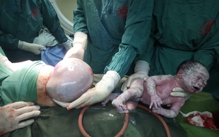 Hy hữu: Sản phụ Quảng Ninh sinh đôi, một trong hai bé còn nguyên trong túi ối