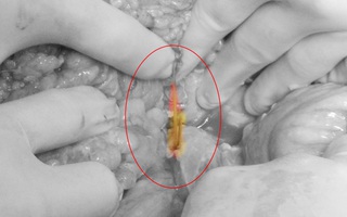 Nhậu xỉn uống luôn ly bia có tăm xỉa răng khi đi tiệc cưới, người đàn ông thủng tá tràng suýt chết