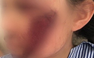 Áo chống nắng cuốn vào bánh xe khiến nữ sinh tổn thương mặt nghiêm trọng
