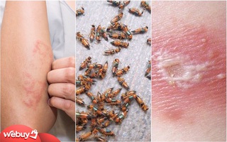 Góc phòng xa: Bị kiến ba khoang đốt lên mặt, chị em nên dùng loại kem trị sẹo nào?