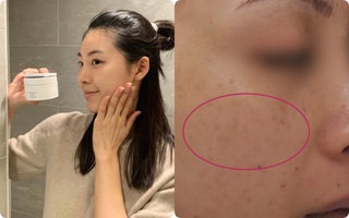 Trước khi đầu tư một lọ kem trị nám/ tàn nhang, nàng 30+ cần tìm hiểu thật kỹ 2 điều này, cẩn thận không "nát mặt" như chơi