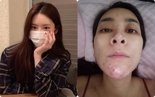 6 tuýp kem trị mụn thần tốc, có tuýp chỉ 35k vẫn diệt mụn tận gốc: Chị em cần mua ngay đề phòng việc đeo khẩu trang kín bưng khiến da chi chít mụn
