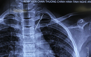 Lấy kim khâu gãy làm 3 trong lưng bé 9 tuổi