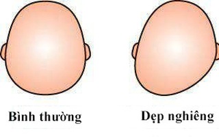 Mẹo nhỏ giúp mẹ bỉm sữa phát hiện dễ dàng những bất thường về hình dáng đầu của con