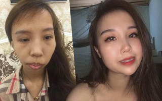 26 năm tủi hờn vì những lời miệt thị do teo nửa bên mặt và hành trình "lột xác" đáng kinh ngạc với 5 cuộc "dao kéo" của bà mẹ 2 con