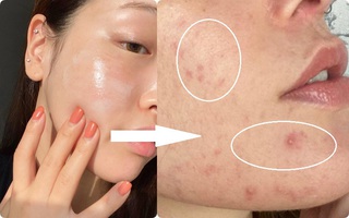4 thành phần "trẻ hóa" đỉnh cao nhưng nếu dùng quá tay, làn da sẽ chịu hậu quả