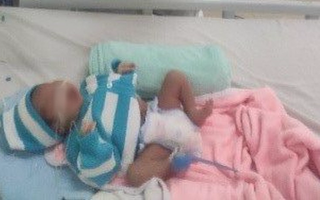 Tiếp nhận điều trị bé sơ sinh 14 ngày tuổi mắc COVID-19, nhiễm trùng sơ sinh muộn