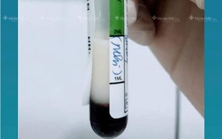 Mẫu máu bất ngờ chuyển màu trắng đục như sữa, bé trai 3 tháng được chẩn đoán mắc bệnh hiếm gặp
