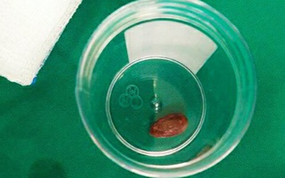 Cứu bé 18 tháng tuổi bị hạt dưa rơi vào phổi