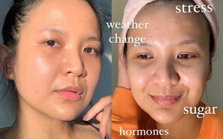 6 thói quen khiến da bạn ngày càng xuống dốc, mãi chẳng thể đẹp nổi