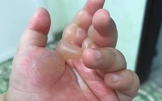 Bé 14 tháng tuổi bị bỏng bô phồng rộp bàn tay: 2 loại thuốc bố mẹ cần có trong nhà và lưu ý để phòng tránh di chứng bỏng cho trẻ