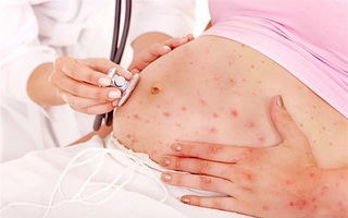 Những biến chứng nguy hiểm khó lường với con nếu mẹ bị thủy đậu khi mang thai
