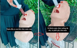 Con bị chảy máu cam, cha mẹ rất hay phạm phải 1 sai lầm này