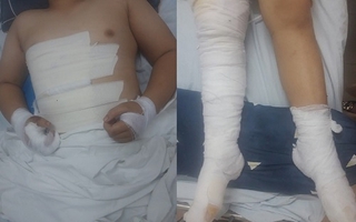 Mê bẫy chim, bé trai bị điện giật gây tổn thương nghiêm trọng