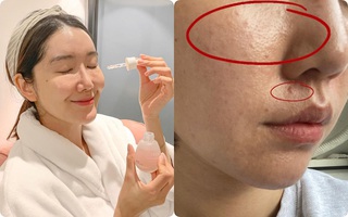 Cải thiện lỗ chân lông to ngoác: 5 điều nhất định phải làm để da dẻ láng mịn không gợn vết tích 