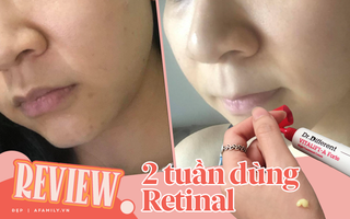 Trải nghiệm 2 tuần dùng Retinal: Vết thâm trên da mình mờ nhanh và bất ngờ nhất là mụn ẩn giảm rõ 