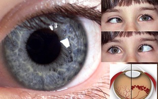 Đừng chủ quan khi thấy mắt con sáng lóe buổi tối