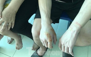 Kinh hoàng chó dại cắn liên tiếp 6 người ở Lạng Sơn