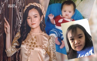 Màn lột xác của cô gái 23 năm bị chê bai "mặt giống khỉ": Liên tiếp trải qua 10 cuộc phẫu thuật kinh hoàng, nhan sắc giờ đây khiến nhiều người phải trầm trồ