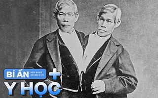 Kỳ lạ cuộc đời hai anh em song sinh mắc bệnh lạ, bị dính liền nhưng vẫn cưới vợ sinh con cùng nhau, khi kết hôn còn bị cả thế giới đòi... kết án tù