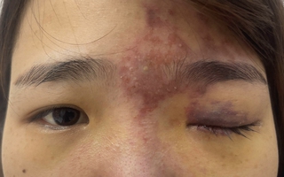 Hoại tử đến tận hốc mắt, suýt mù sau khi tiêm filler nâng mũi tại spa