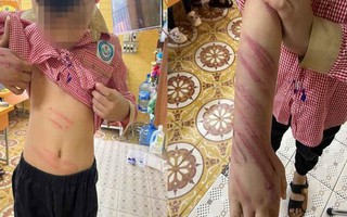 Xác minh vụ bé trai 8 tuổi bị người tình của mẹ bạo hành