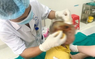 Bé 3 tuổi bị chó hàng xóm cắn trọng thương vùng đầu, mặt
