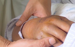 Bị rắn độc tấn công, bệnh nhi nguy kịch vì đắp thuốc thầy lang