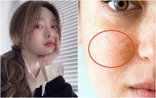 9 mẹo đối phó với tàn nhang trên mặt