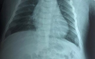 Trẻ 2 tháng tuổi khó thở khi nuốt phải dị vật