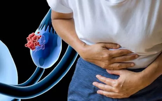 Các dấu hiệu ung thư buồng trứng khó phân biệt với các tình trạng bệnh khác