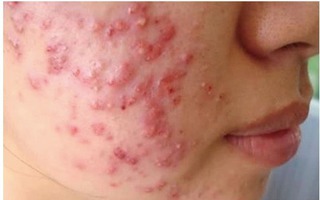 Mặt chi chít mụn sau dùng kem dưỡng ẩm mùa hè, bác sĩ chỉ ra sai lầm nhiều bạn gái trẻ mắc phải