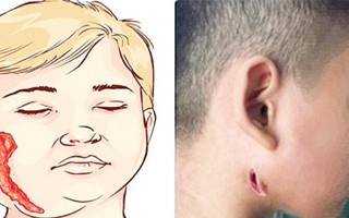 BS Trương Hữu Khanh nói về căn bệnh bị gọi tên 'vi khuẩn ăn thịt người'