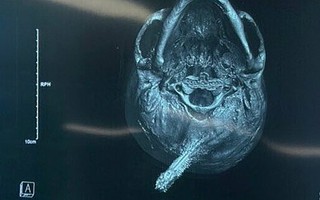 Chìa khóa cắm xương sọ nam thanh niên