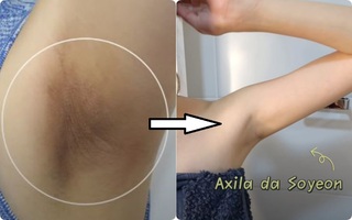 Trị thâm cho vùng nách: Cách nhanh gọn được beauty blogger xứ Hàn duy trì suốt 10 năm không đổi