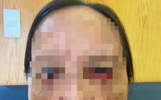 Cứu chữa đôi mắt lật ngược, trợn trừng sau làm đẹp của người phụ nữ