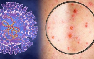 4 giai đoạn diễn biến bệnh đậu mùa khỉ: Triệu chứng từ nhẹ đến nặng