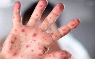Cha mẹ cần làm gì khi trẻ mắc bệnh đậu mùa khỉ?