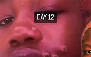 Câu chuyện sốc của người phụ nữ Mỹ đầu tiên mắc bệnh đậu mùa khỉ