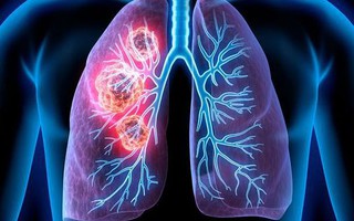 2 vợ chồng cùng mắc ung thư phổi: Bác sĩ chỉ ra nguyên nhân