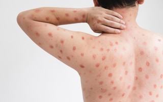 Xuất hiện dịch "cúm cà chua" rất dễ lây lan ở trẻ em tại Ấn Độ