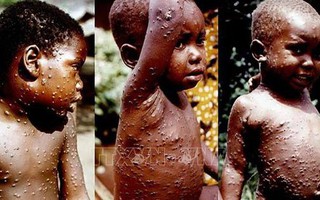 Cảnh báo nguy cơ lây lan virus đậu mùa khỉ ở trẻ em