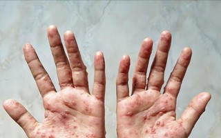 Mỹ ghi nhận ca tử vong đầu tiên vì bệnh đậu mùa khỉ