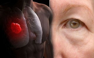 Nếu có 4 dấu hiệu bất thường ở đầu, hãy cảnh giác sự xuất hiện của ung thư phổi