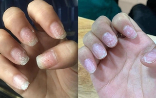 Tình trạng chung của chị em sau Tết: Làm nail hết mình, tháo nail hết hồn