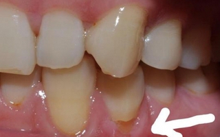 Răng vỡ rụng từng mảng vì cách đánh răng sai nhiều người mắc