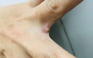 Trẻ em có nguy cơ cao mắc đậu mùa khỉ?