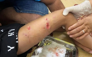 Ra đường chơi, bé 4 tuổi bị chó hàng xóm cắn dữ dội